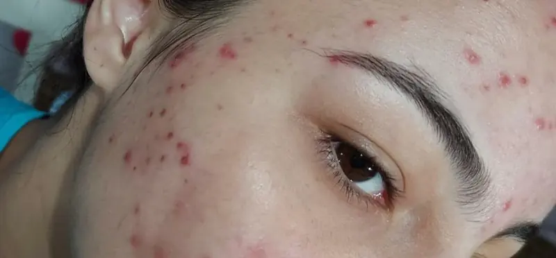 Antes: acne no rosto