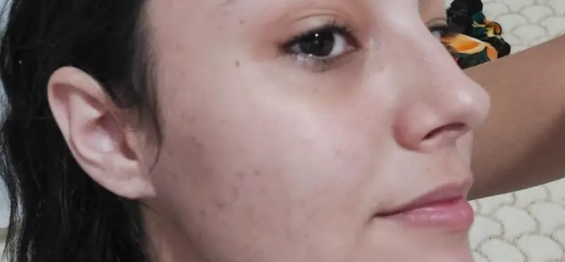 Depois do tratamento com a Juliani