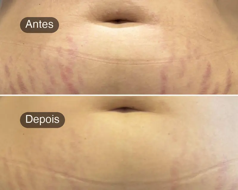 Antes e depois de estrias no abdômen de uma cliente da Juliani