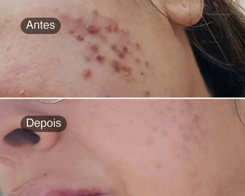 Antes e depois de acne no rosto de uma cliente